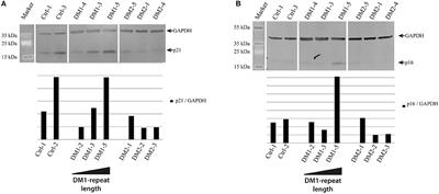 Myotonic Dystrophy—A Progeroid Disease?